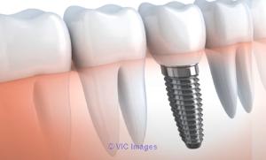 The Dental Implants Cost in Sydney is $2,850 - Dr Paulo Pinho