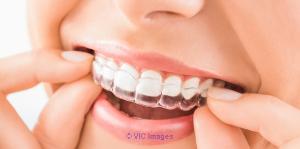 Invisible Braces in Sydney from $1650 - Call Now