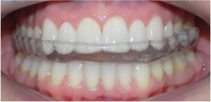 tmj dentist in calgary