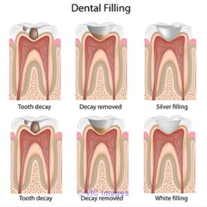 Best Front Tooth Cavity Filling or Dental Fillings in Calgary