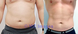 Fat removal options in Etobicoke, ON