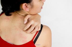 Best Cream for Itching Relief