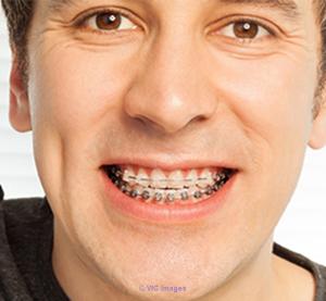 Affordable Denture Clinic in SE Calgary - Galaxy Dental