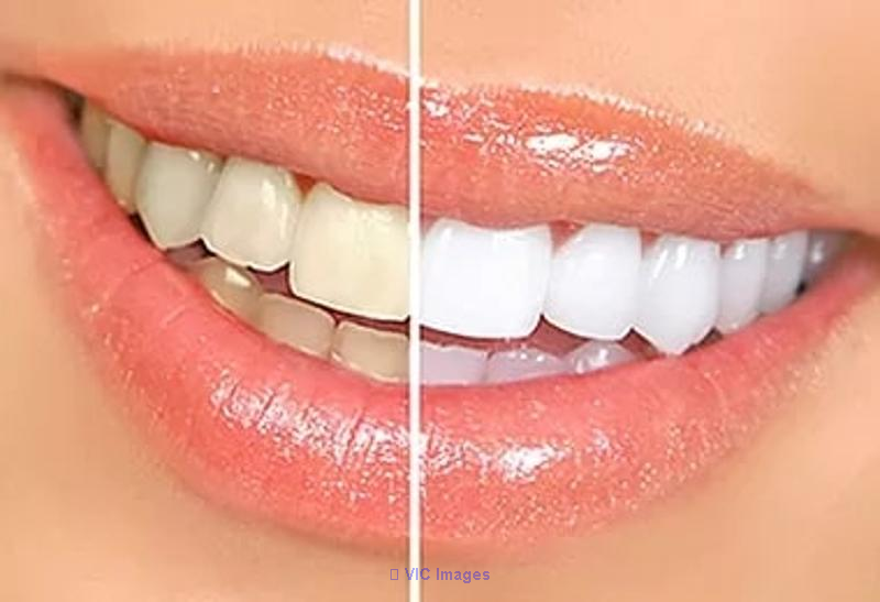 Get Teeth Whitening Treatment in Calgary from Galaxy Dental