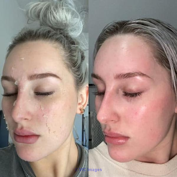 Chemical Peel near me in waterloo