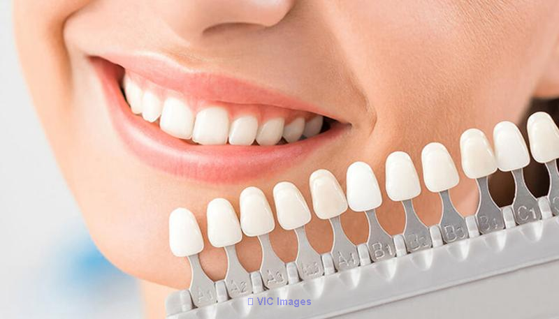 Dental Crowns and Bridges in Kitchener | Dental Bridges