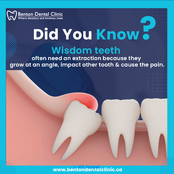 Wisdom Teeth Extraction in Kitchener | Wisdom Teeth Removal