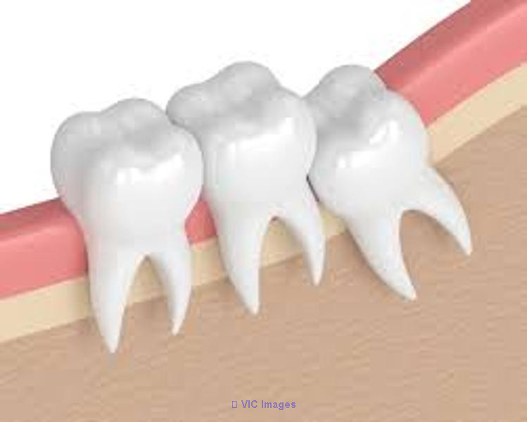 Best wisdom Teeth extractions at New Market Dental Health Clinic