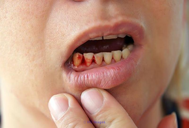 Gum Disease Assessment And Treatment