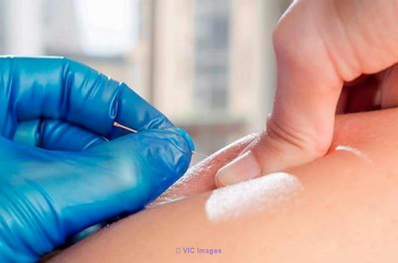 IMS/dry needling is it a trigger point therapy?