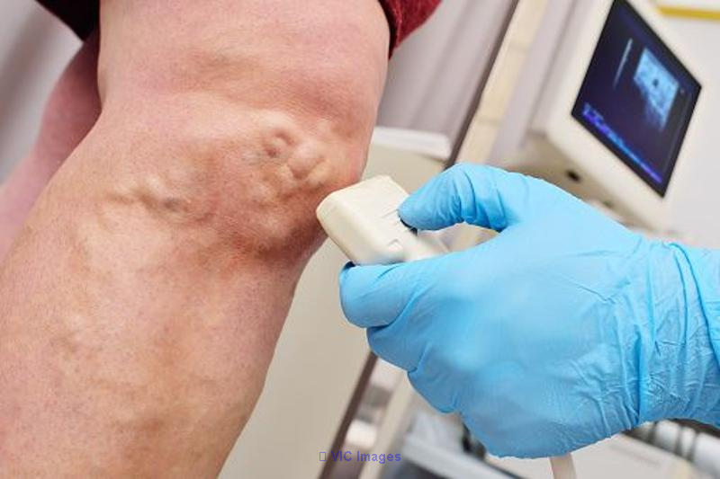 Be Vein-Free and Radiant: Customized Solutions for Varicose and Spider
