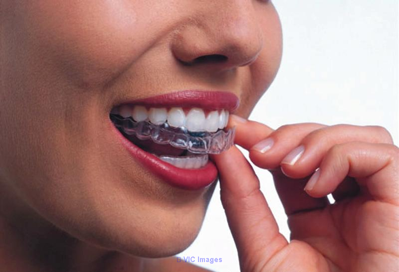 Oakville Mouth Guard Services