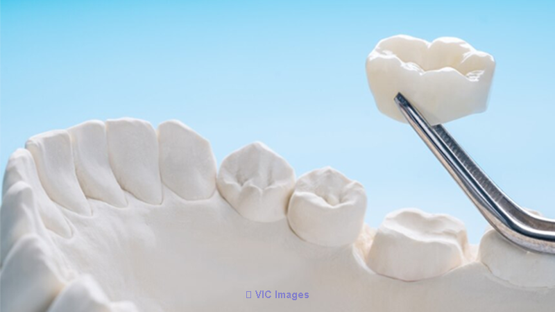 Dental Crowns in Oakville